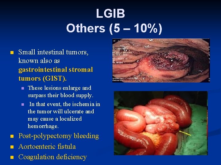 LGIB Others (5 – 10%) n Small intestinal tumors, known also as gastrointestinal stromal