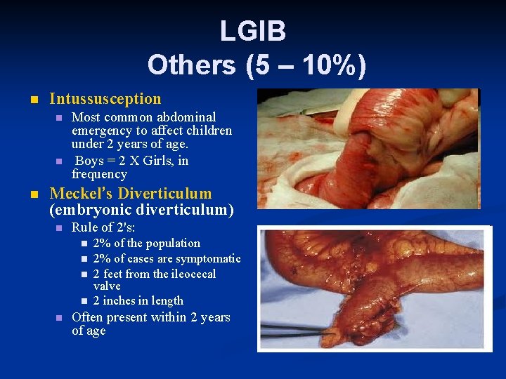LGIB Others (5 – 10%) n Intussusception n Most common abdominal emergency to affect