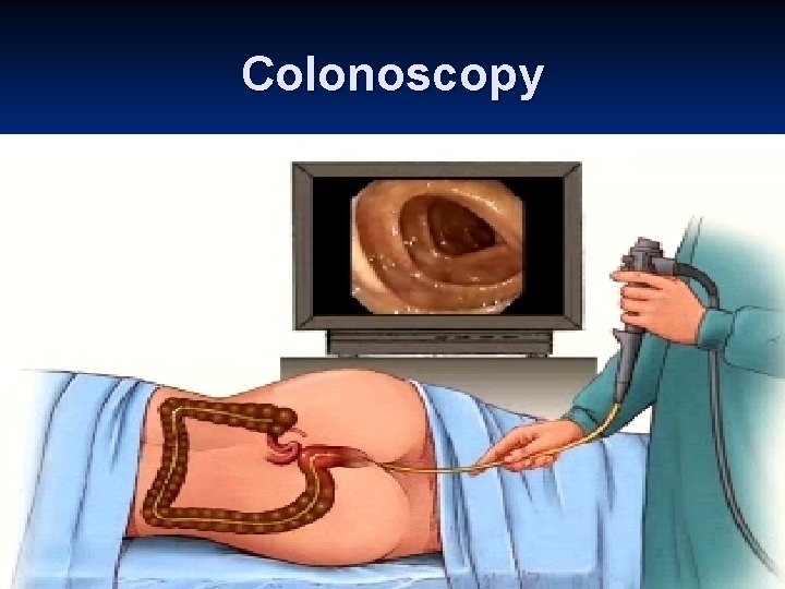 Colonoscopy 