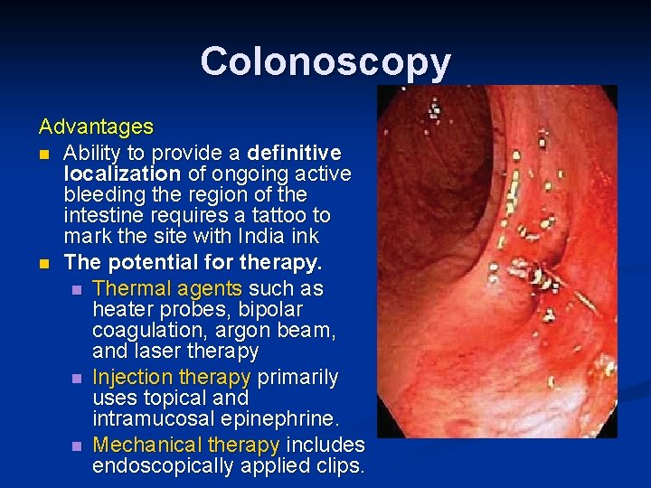 Colonoscopy Advantages n Ability to provide a definitive localization of ongoing active bleeding the