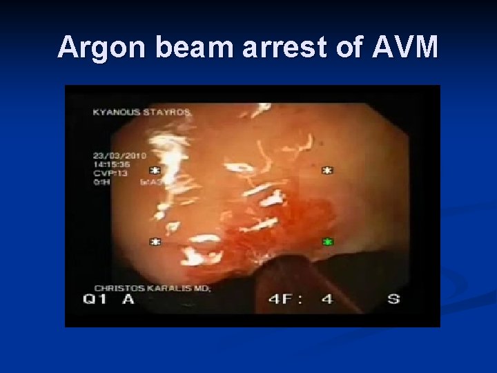Argon beam arrest of AVM 