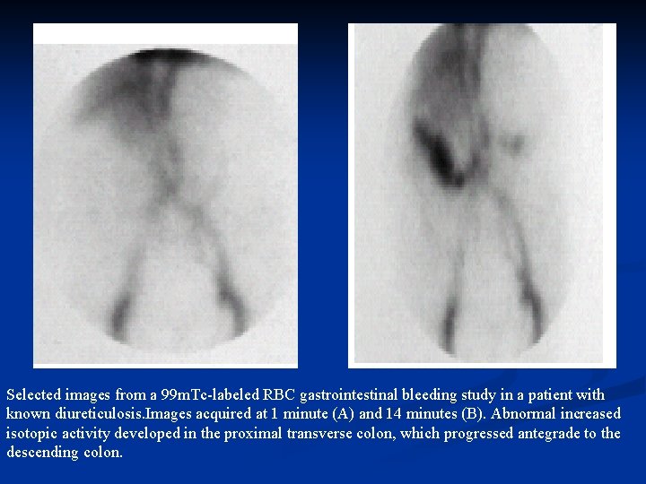 Selected images from a 99 m. Tc-labeled RBC gastrointestinal bleeding study in a patient