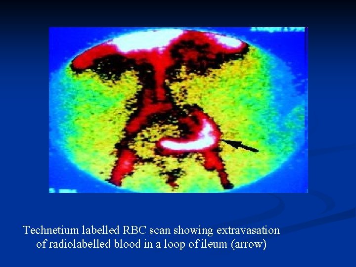 Technetium labelled RBC scan showing extravasation of radiolabelled blood in a loop of ileum