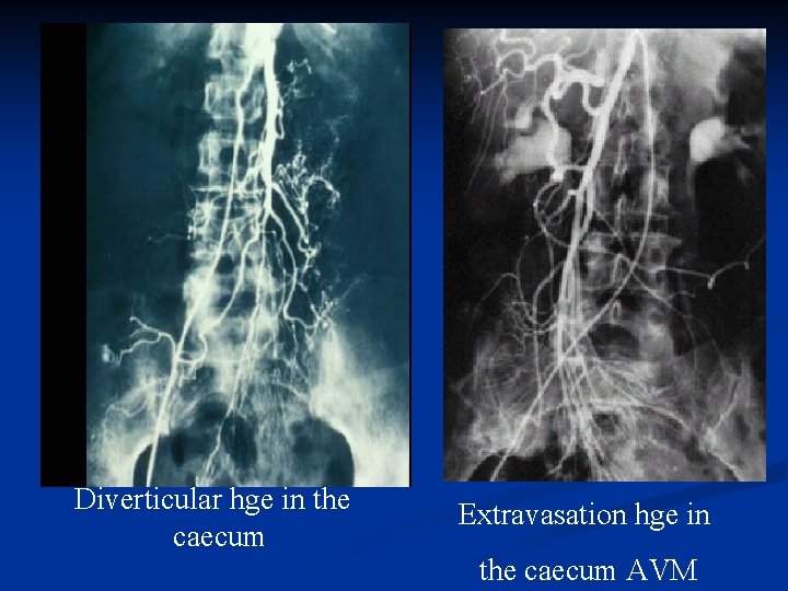 Diverticular hge in the caecum Extravasation hge in the caecum AVM 