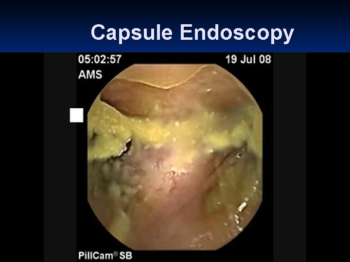 Capsule Endoscopy 