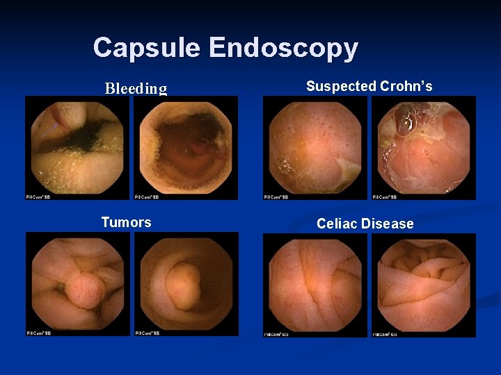 Capsule Endoscopy Bleeding Tumors Suspected Crohn’s Celiac Disease 