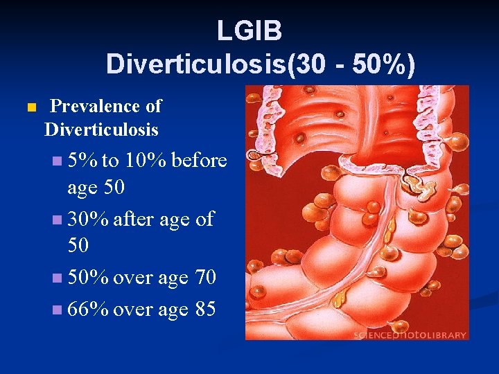 LGIB Diverticulosis(30 - 50%) n Prevalence of Diverticulosis n 5% to 10% before age