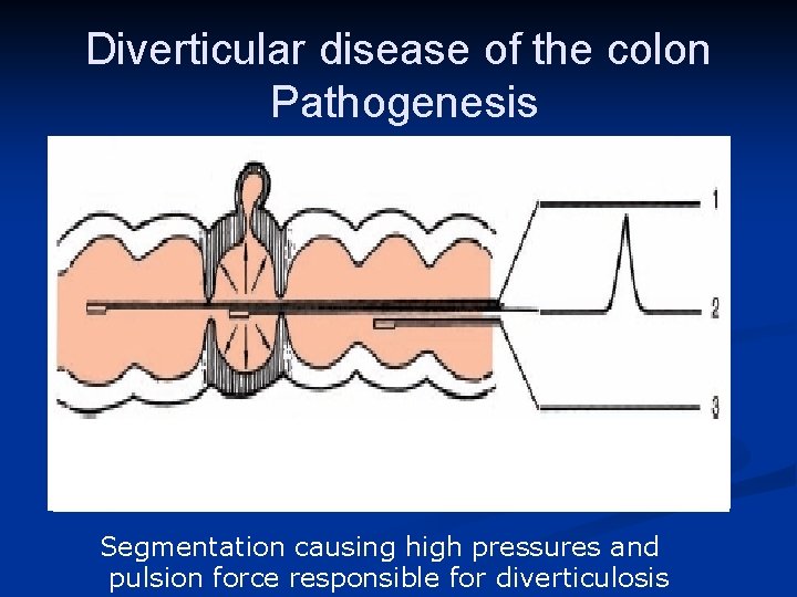 Diverticular disease of the colon Pathogenesis Segmentation causing high pressures and pulsion force responsible
