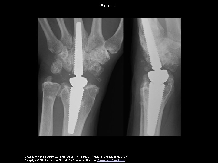 Figure 1 Journal of Hand Surgery 2018 431044. e 1 -1044. e 4 DOI: