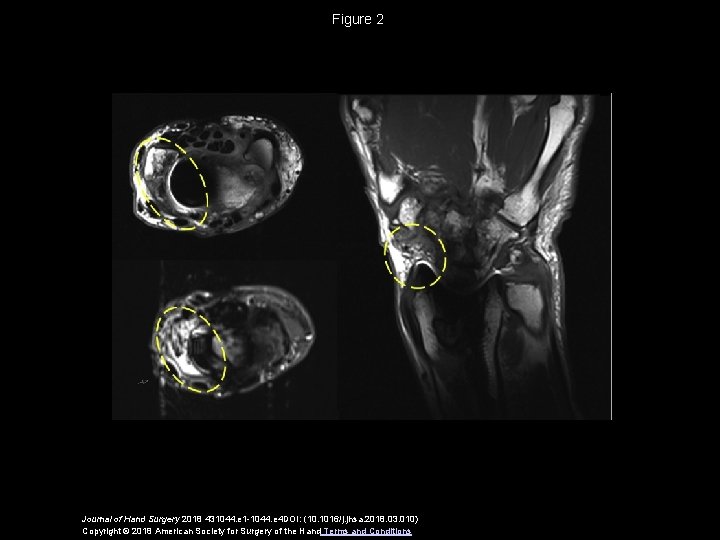 Figure 2 Journal of Hand Surgery 2018 431044. e 1 -1044. e 4 DOI: