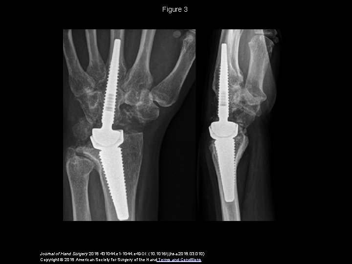 Figure 3 Journal of Hand Surgery 2018 431044. e 1 -1044. e 4 DOI: