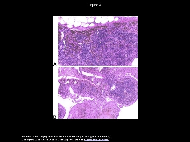 Figure 4 Journal of Hand Surgery 2018 431044. e 1 -1044. e 4 DOI: