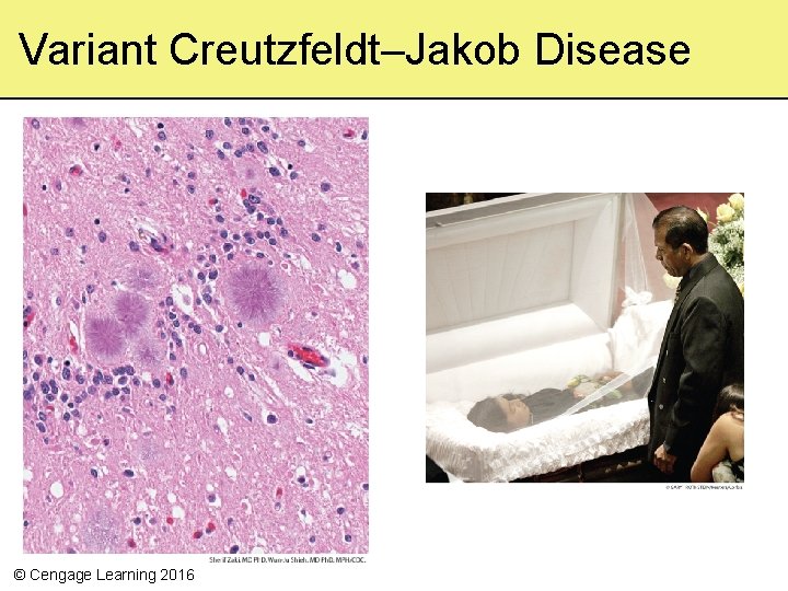 Variant Creutzfeldt–Jakob Disease © Cengage Learning 2016 
