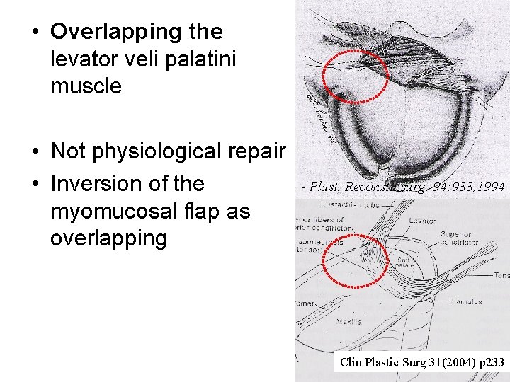  • Overlapping the levator veli palatini muscle • Not physiological repair • Inversion