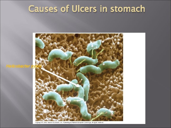 Causes of Ulcers in stomach Helicobacter pylori 