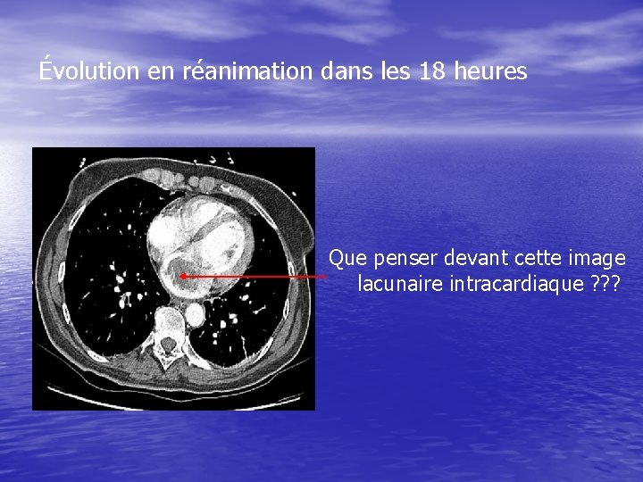 Évolution en réanimation dans les 18 heures Que penser devant cette image lacunaire intracardiaque