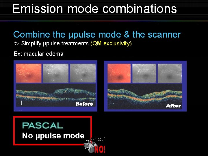 Emission mode combinations Combine the µpulse mode & the scanner Simplify µpulse treatments (QM