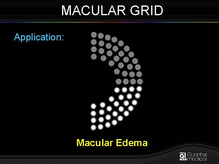 MACULAR GRID Application: Macular Edema 