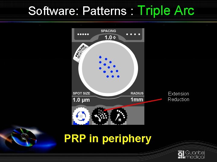 Software: Patterns : Triple Arc Extension Reduction PRP in periphery 