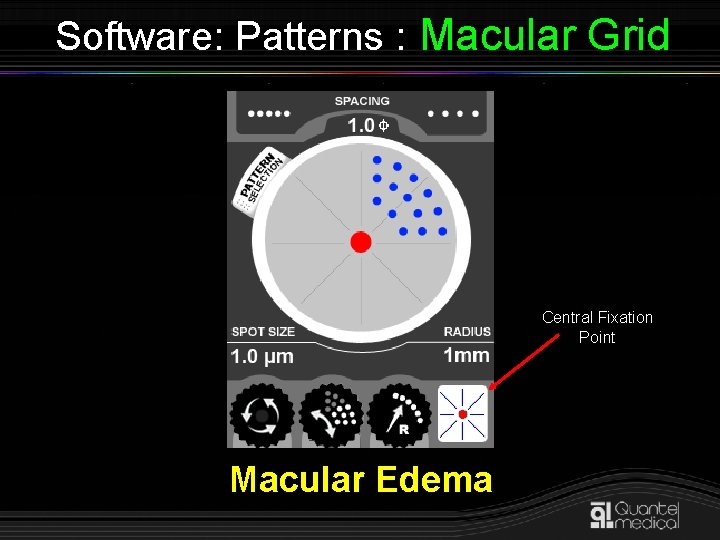 Software: Patterns : Macular Grid Central Fixation Point Macular Edema 