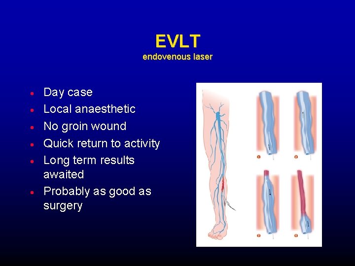 EVLT endovenous laser Day case Local anaesthetic No groin wound Quick return to activity