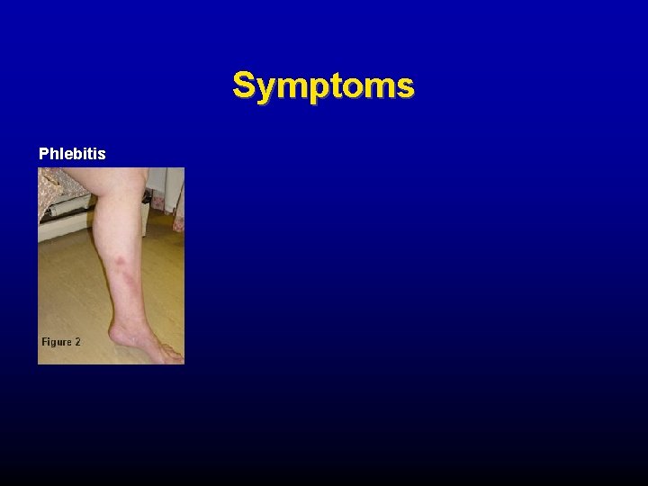 Symptoms Phlebitis 