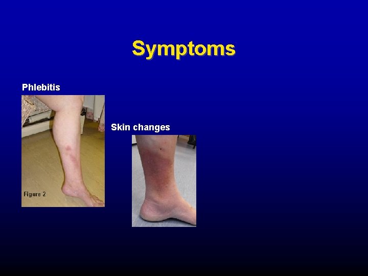 Symptoms Phlebitis Skin changes 