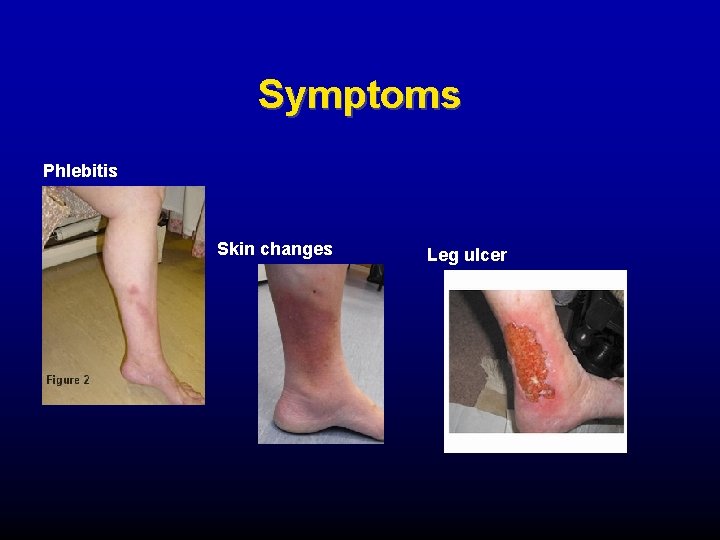 Symptoms Phlebitis Skin changes Leg ulcer 