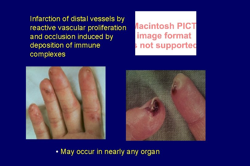 Infarction of distal vessels by reactive vascular proliferation and occlusion induced by deposition of