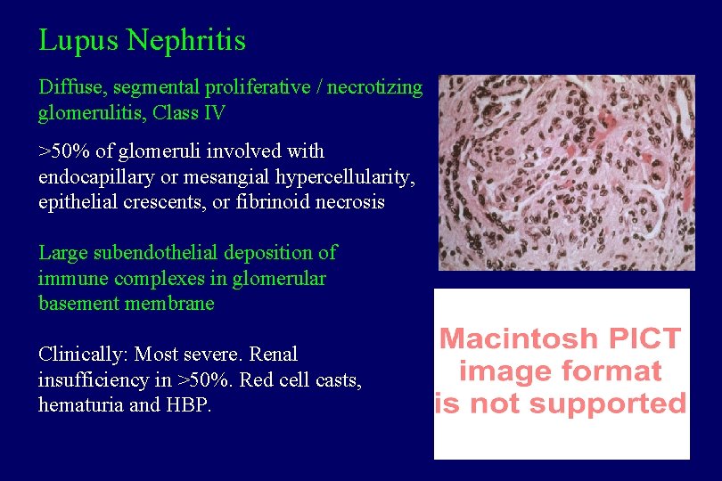 Lupus Nephritis Diffuse, segmental proliferative / necrotizing glomerulitis, Class IV >50% of glomeruli involved