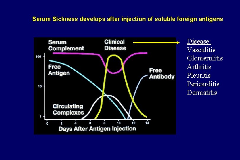 Serum Sickness develops after injection of soluble foreign antigens Disease: Vasculitis Glomerulitis Arthritis Pleuritis