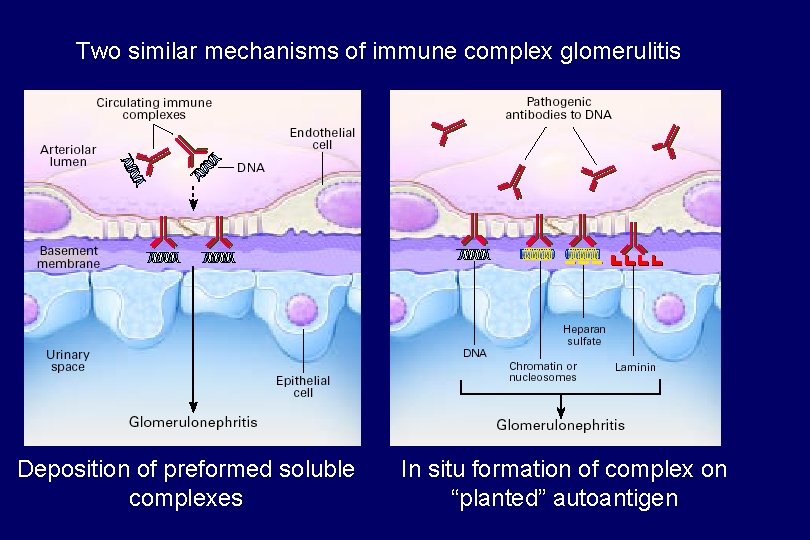 Two similar mechanisms of immune complex glomerulitis Deposition of preformed soluble complexes In situ