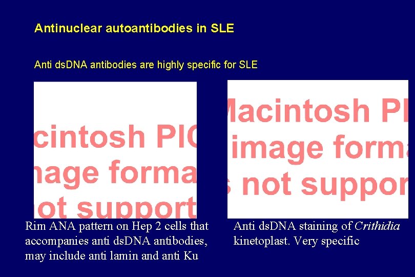 Antinuclear autoantibodies in SLE Anti ds. DNA antibodies are highly specific for SLE Rim