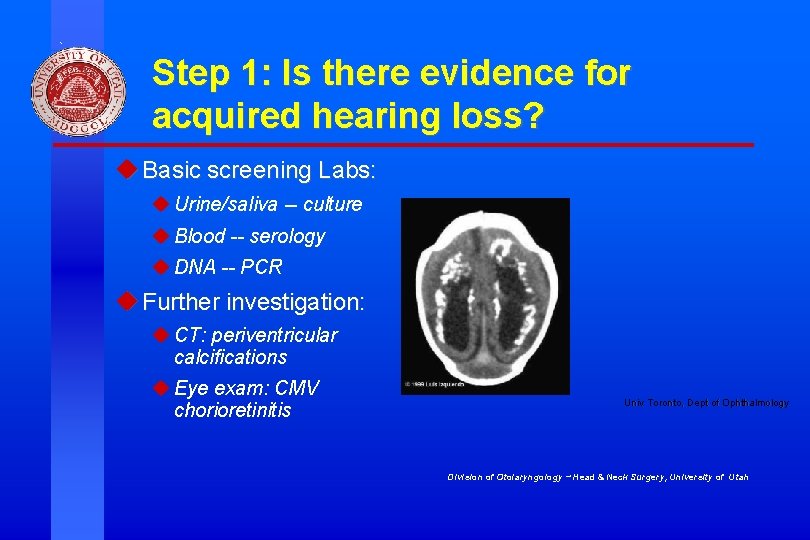 Step 1: Is there evidence for acquired hearing loss? u Basic screening Labs: u Step 1: Is there evidence for acquired hearing loss? u Basic screening Labs: u