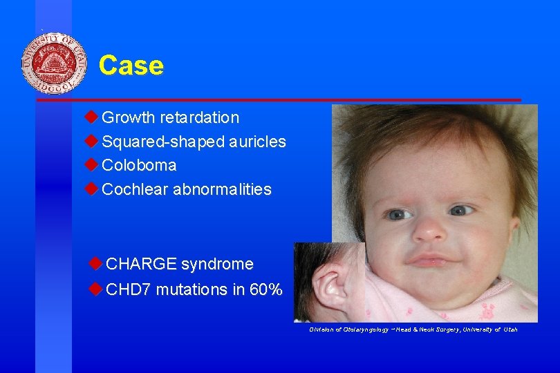 Case u Growth retardation u Squared-shaped auricles u Coloboma u Cochlear abnormalities u CHARGE Case u Growth retardation u Squared-shaped auricles u Coloboma u Cochlear abnormalities u CHARGE