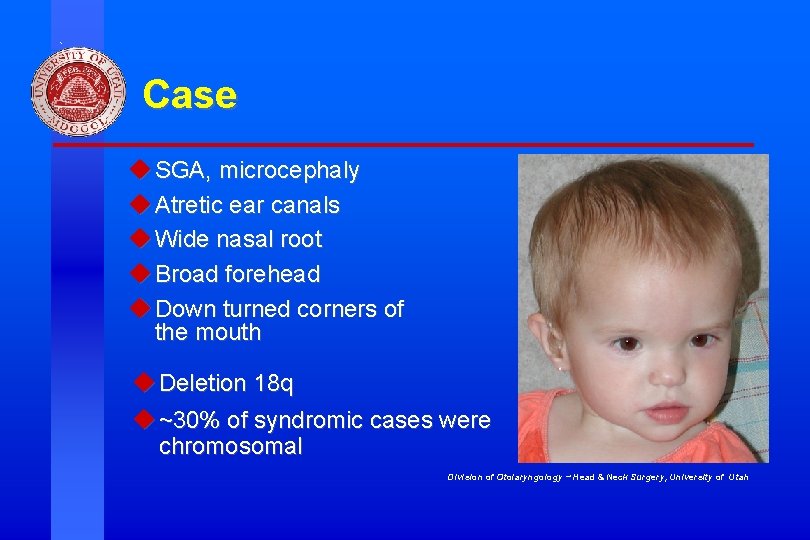 Case u SGA, microcephaly u Atretic ear canals u Wide nasal root u Broad