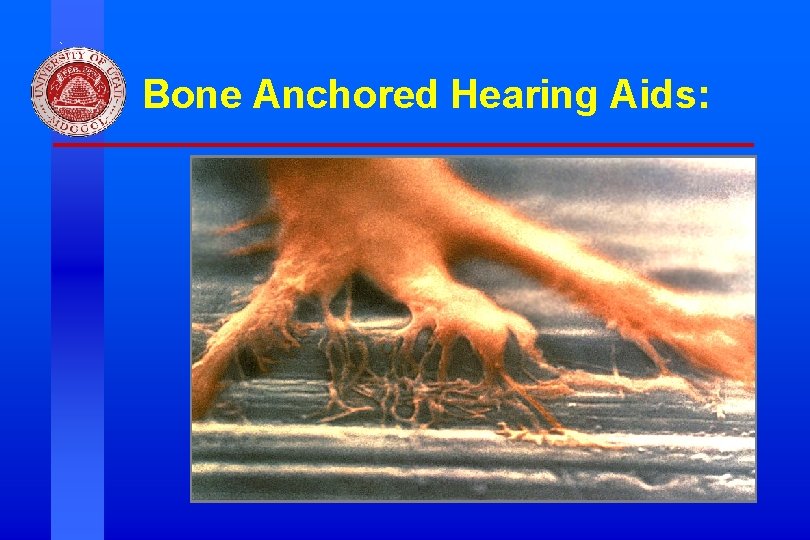 Bone Anchored Hearing Aids: Division of Otolaryngology ~ Head & Neck Surgery, University of