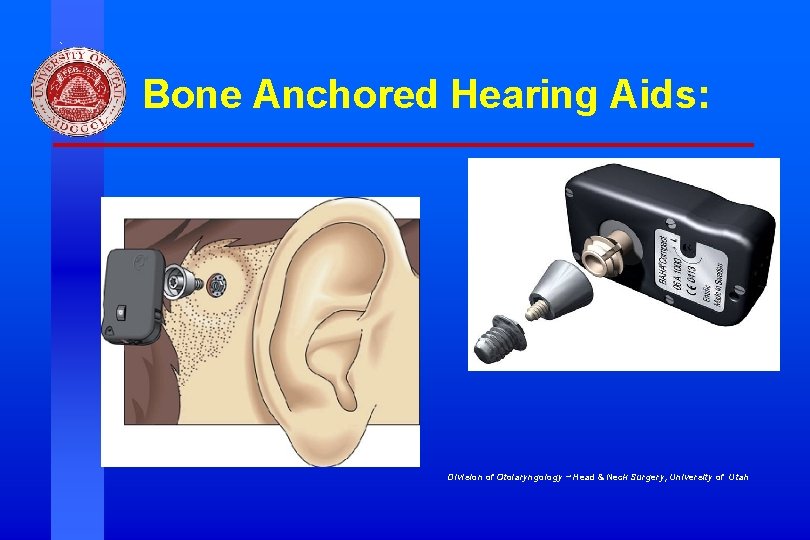 Bone Anchored Hearing Aids: Division of Otolaryngology ~ Head & Neck Surgery, University of