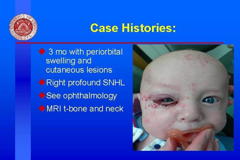 Case Histories: u 3 mo with periorbital swelling and cutaneous lesions u. Right profound Case Histories: u 3 mo with periorbital swelling and cutaneous lesions u. Right profound
