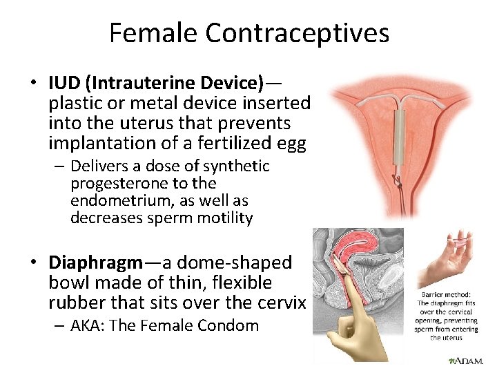 Female Contraceptives • IUD (Intrauterine Device)— plastic or metal device inserted into the uterus Female Contraceptives • IUD (Intrauterine Device)— plastic or metal device inserted into the uterus