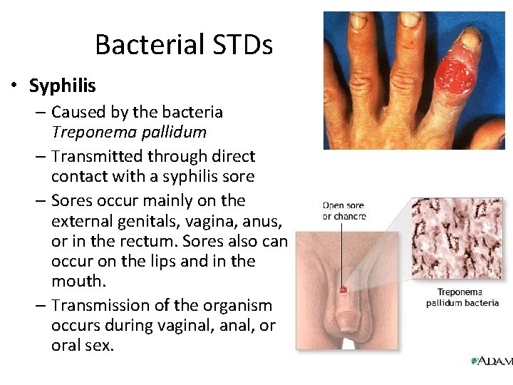 Bacterial STDs • Syphilis – Caused by the bacteria Treponema pallidum – Transmitted through Bacterial STDs • Syphilis – Caused by the bacteria Treponema pallidum – Transmitted through