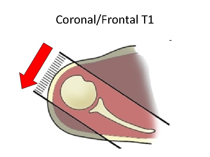 Coronal/Frontal T 1 