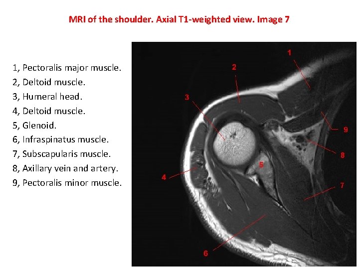 MRI of the shoulder. Axial T 1 -weighted view. Image 7 1, Pectoralis major