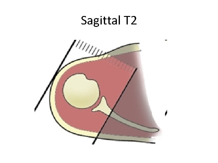 Sagittal T 2 