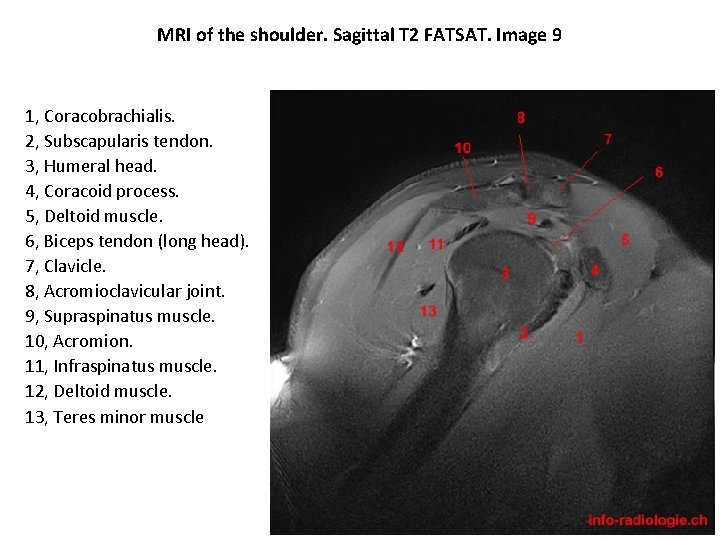 MRI of the shoulder. Sagittal T 2 FATSAT. Image 9 1, Coracobrachialis. 2, Subscapularis