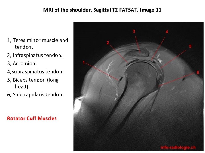 MRI of the shoulder. Sagittal T 2 FATSAT. Image 11 1, Teres minor muscle