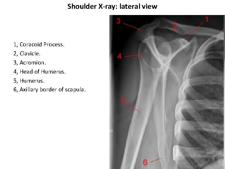 Shoulder X-ray: lateral view 1, Coracoid Process. 2, Clavicle. 3, Acromion. 4, Head of