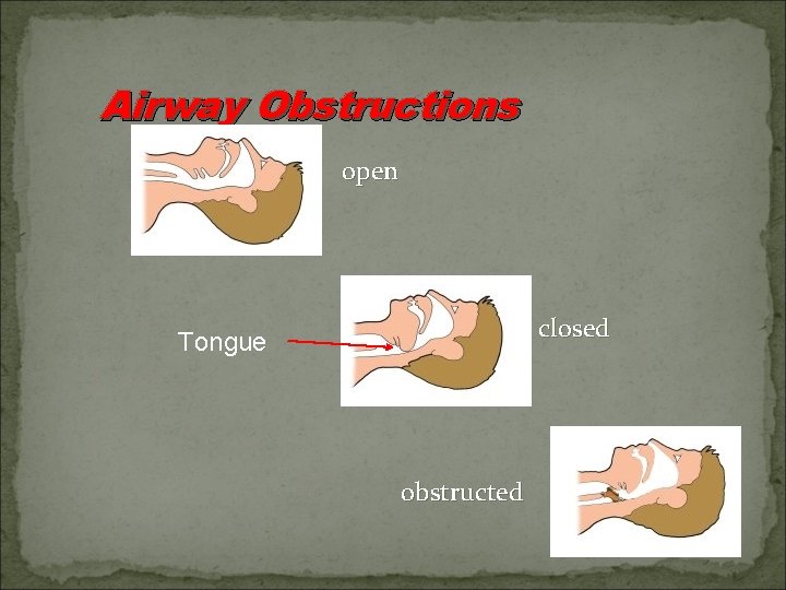 Airway Obstructions open closed Tongue obstructed 