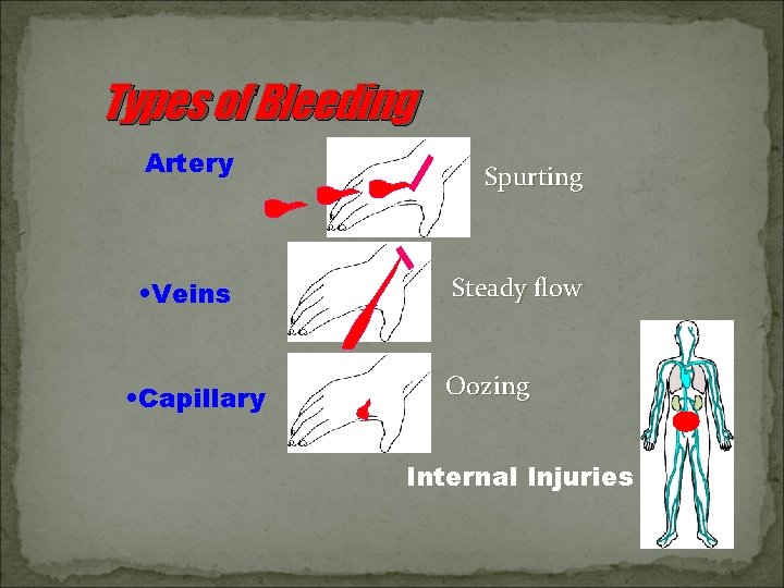Types of Bleeding Artery • Veins • Capillary Spurting Steady flow Oozing Internal Injuries