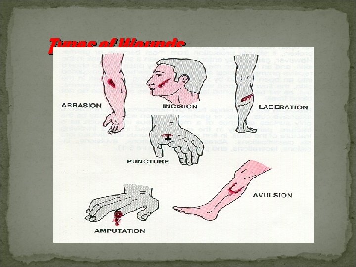 Types of Wounds 